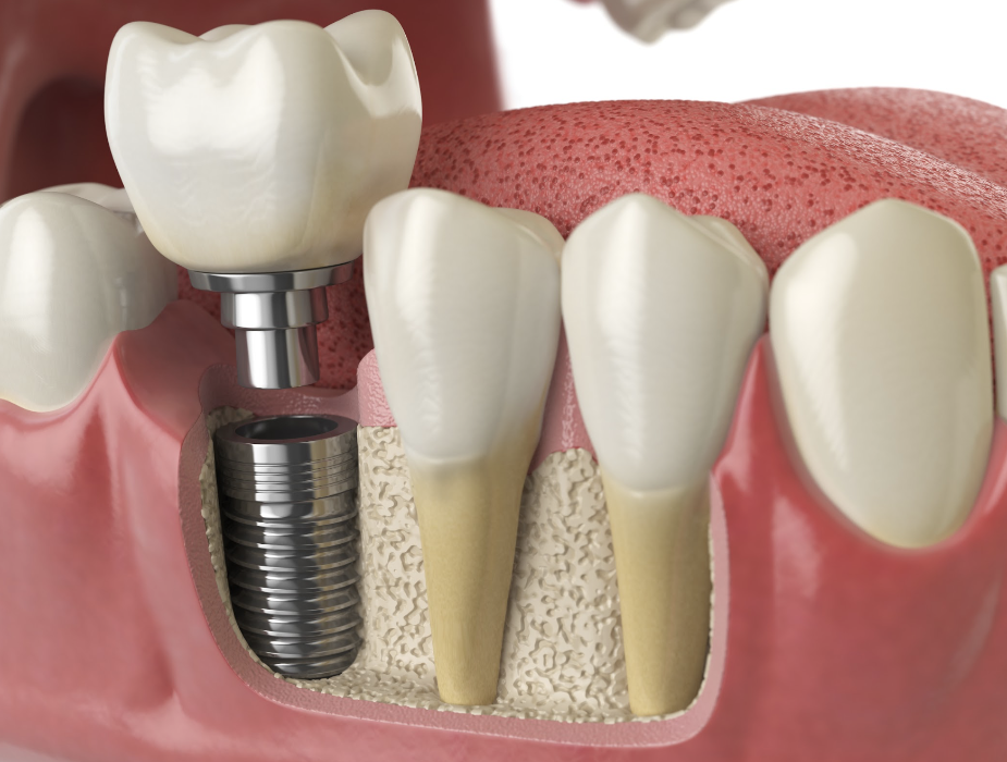 dental implants in narre warren