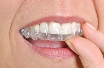 invisalign narre warren vic