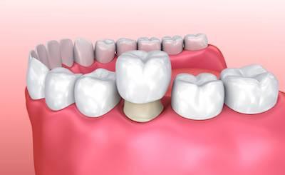 dental crown narre warren vic