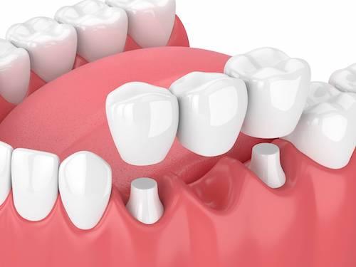 dental bridges narre warren vic