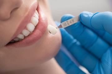 dental veneers narre warren vic