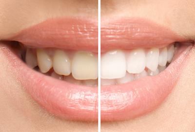 teeth whitening services narre warren