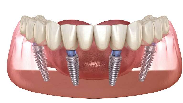 all on x dental implants narre warren 