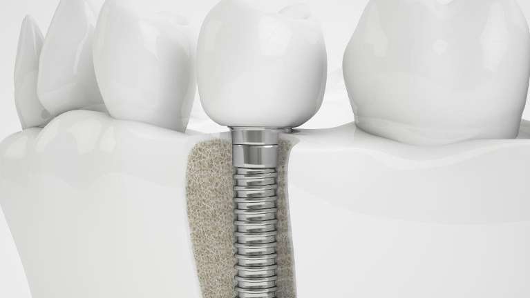 dental implants in narre warren