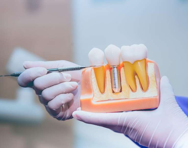image of a dental implant in narre warren
