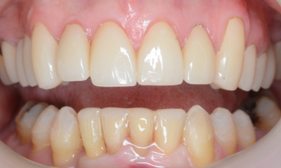 After treatment - Clear Aligners and Crowns/Veneers