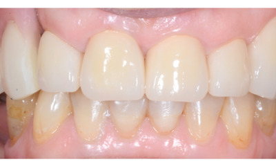 After treatment - Dentures, Crowns and Bite Reconstruction