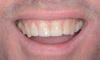After treatment - Edge Bonding for Chipped Teeth