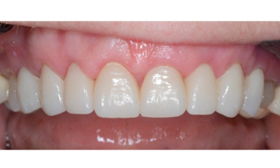 After treatment - Gum Lift, Crown and Veneers