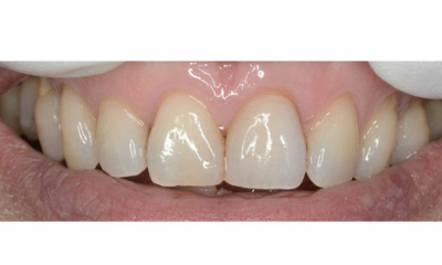 After treatment - Single Crown Colour Matching 