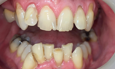 Before treatment - Clear Aligners and Crowns/Veneers