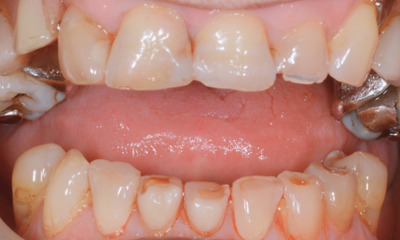 Before treatment - Dentures, Crowns and Bite Reconstruction