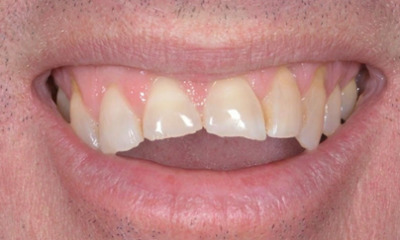 Before treatment - Edge Bonding for Chipped Teeth