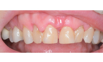 Before treatment - Gum Lift, Crown and Veneers