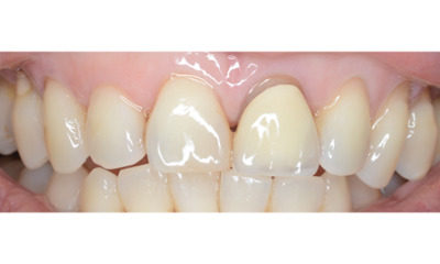 Before treatment - Single Crown Colour Matching 