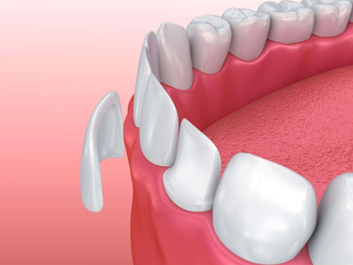 Porcelain Veneers Narre Warren